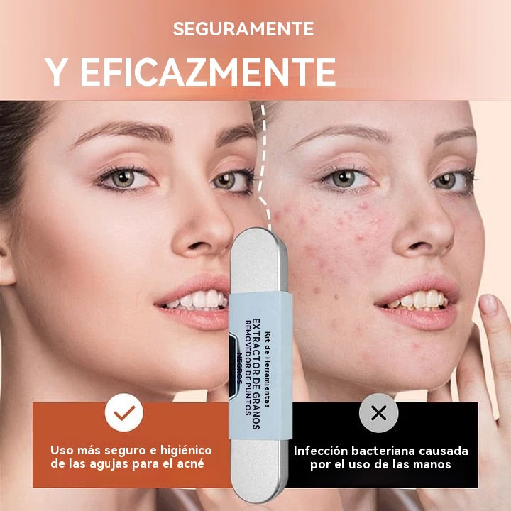【Compra 1 y llévate 1 gratis】💓Descuento de último día💥Juego de herramientas de grado médico para eliminar puntos negros
